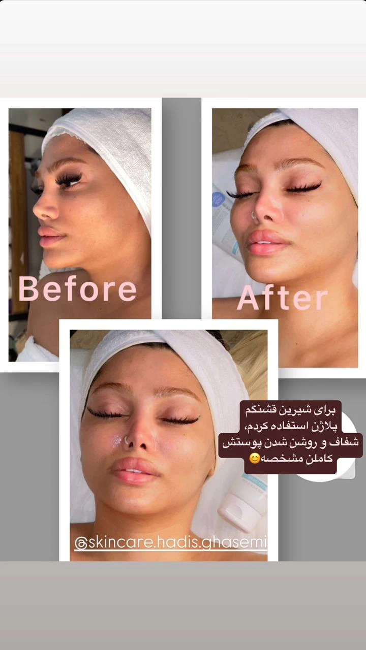 فشیال و پاکسازی پوست اوپال