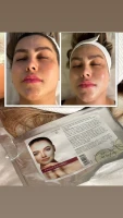 فشیال و پاکسازی پوست اوپال