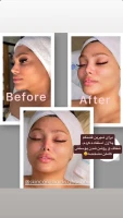 فشیال و پاکسازی پوست اوپال