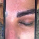 فیشال تخصصی و درمان جوش ولک Zhikan