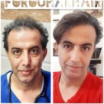 تصویر کلینیک تخصصی کاشت مو و ابروی فروهر