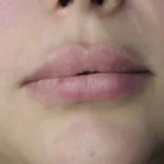 کلینیک  هایفو تراپی لیزر ‌بوتاکس لاویش