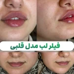 فیلر و بوتاکس  بیوتی