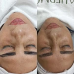 لیزر موهای زائد و پاکسازی پوست نوترسا