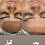 پاکسازی و جوانسازی پوست سمیرا صادقی