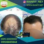 لوگوی کاشت مو ایران فیت