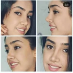 تصویر جراحی  زیبایی بینی  و صورت نئوفیس