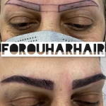 تصویر کلینیک تخصصی کاشت مو و ابروی فروهر