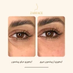 کلینیک تزریق فیلر و بوتاکس زرفیس