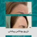 کلینیک تزریق بوتاکس و فیلر نارینا