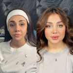نمونه کار کلینیک زیبایی و جراحی دکتر محسن حسینی