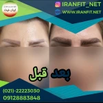 کاشت مو ایران فیت
