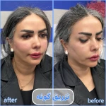 تصویر برفین اسکین