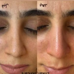 فیشال تخصصی و درمان جوش ولک Zhikan