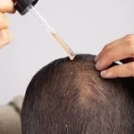 نمونه کار اسکالپ تراپی عارفه باقری