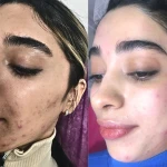 نمونه کار کلینیک پوست، مو، زیبایی دکتر نوشین پیروی