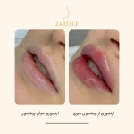 کلینیک تزریق فیلر و بوتاکس زرفیس