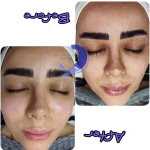 فیشال تخصصی و درمان جوش ولک Zhikan