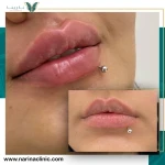 نمونه کار کلینیک تزریق بوتاکس و فیلر نارینا