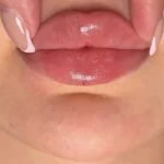تصویر خانه لیزر فیلر و بوتاکس ثنا