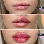 فیلر و بوتاکس  بیوتی