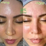 نمونه کار فیشال تخصصی و درمان جوش ولک Zhikan