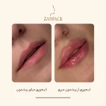 تصویر کلینیک تزریق فیلر و بوتاکس زرفیس