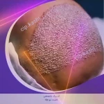 تصویر مرکز کاشت مو و ابرو فیشال cip