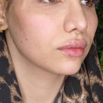 مرکز لیزر ونوس طلایی