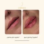 کلینیک تزریق فیلر و بوتاکس زرفیس