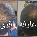 اسکالپ سر عارفه باقری