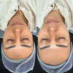 فشیال و پاکسازی پوست النازوید