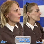 برفین اسکین