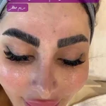 خدمات تخصصی فیشال و پاکسازی پوست حفظی