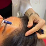 کلینیک  هایفو تراپی لیزر ‌بوتاکس لاویش