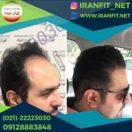 کاشت مو ایران فیت