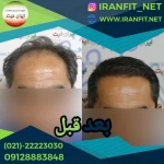نمونه کار کاشت مو ایران فیت