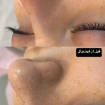 تصویر لیزر موهایی زائد بیوتینا