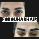 کلینیک تخصصی کاشت مو و ابروی فروهر