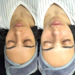 فشیال و پاکسازی پوست النازوید