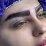 نمونه کار مرکز کاشت مو و ابرو فیشال cip
