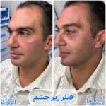تصویر برفین اسکین
