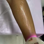 مركز ليزر و لاغري آيسان