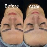 فشیال و پاکسازی پوست النازوید