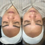 فشیال و پاکسازی پوست النازوید