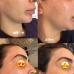 فشیال و پاکسازی پوست اوپال