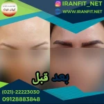 کاشت مو ایران فیت