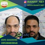 کاشت مو ایران فیت