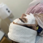 نمونه کار لیزر موهایی زائد بیوتینا