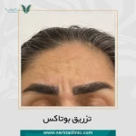 کلینیک تزریق بوتاکس و فیلر نارینا